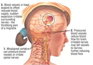 Migraine headaches